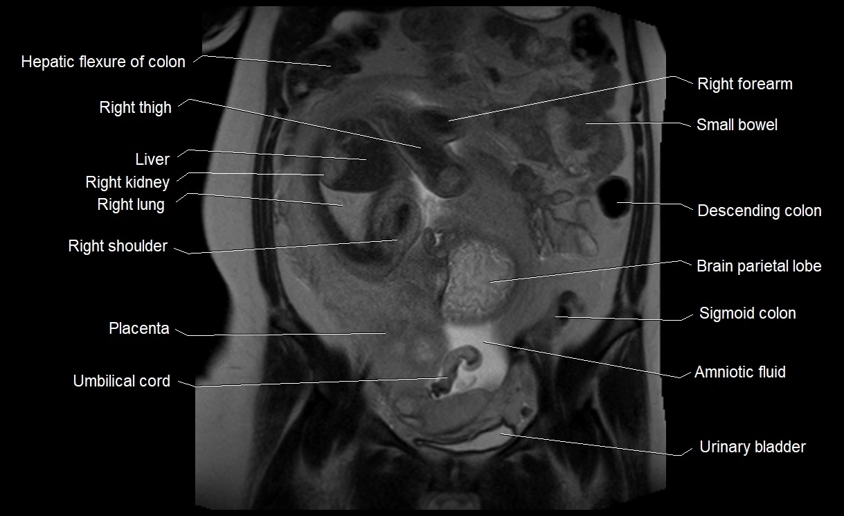 MRI Anatomy of pregnancy image 17.webp
